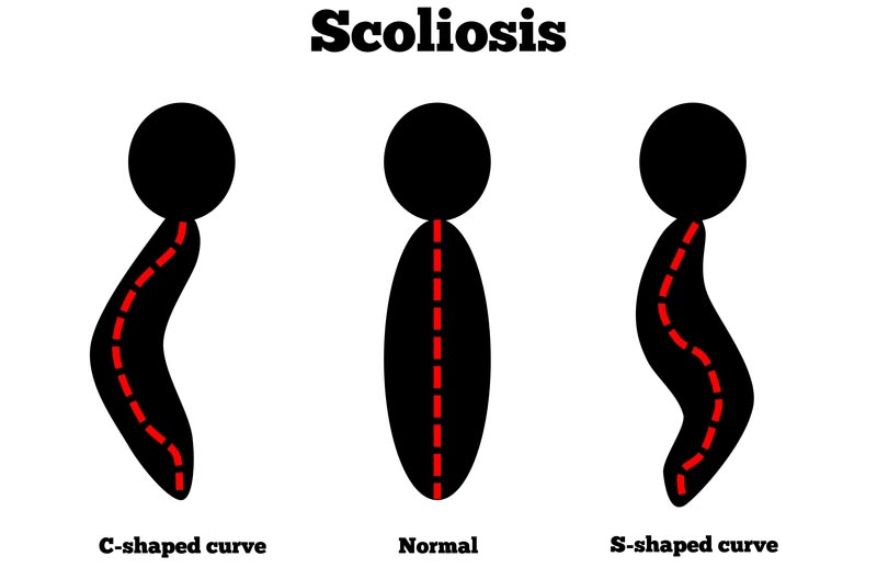 Seattle, WA scoliosis treatment